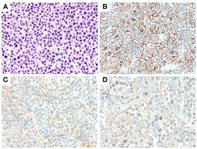 Frontiers Case Reports Central Nervous System Involvement In